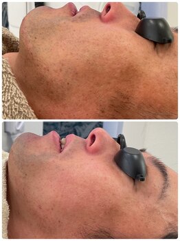 エン(enn)/【髭】