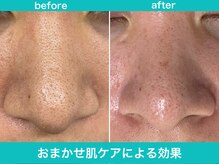 ミスターアンクール 鹿児島(Mr.uncoeur)/おまかせ肌ケア