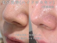 エムラボ 表参道店(M LABO)の雰囲気（頑固な毛穴を徹底的に除去！毛穴ケア人気NO１『ハイドロスキン』）