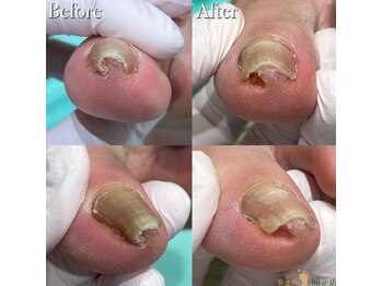 巻き爪補正店 豊田店/【巻き爪/陥入爪】