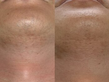 フェリス(FELIZ)/鹿児島ヒゲ脱毛はここ!