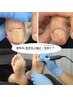 《初回限定》肥厚爪/変形爪ケア＋角質ケア１ヶ所｜原因分析＋再発予防ケア付