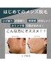【メンズ脱毛★定番人気！髭剃り卒業】☆特別価格☆抜ける！ヒゲ脱毛☆