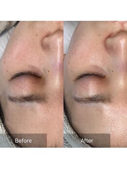 ホワイトアクア 岐阜店(WHITE AQUA)/ララピール/岐阜/毛穴