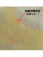 ウェヌ(VENE)/鼻の黒ずみ！！