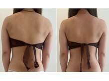 ビューティーマックス(Beauty Max)/痩身　before→after 1.5ヶ月