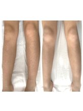 リッカ 学芸大学(RIKKA)/女性　足脱毛　ビフォーアフター