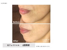 ヴィヴァーチェ(Vivace)/光フェイシャル　Before→after