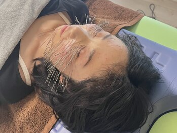 耀 カガヤキ/鬼美容鍼