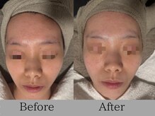 ルミライズ(lumirise)/〈３回目での効果〉