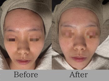 ルミライズ(lumirise)/〈３回目での効果〉