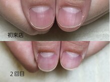 グラシナ なんば店/深爪/自爪育成/フィルイン