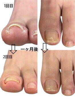 巻き爪ジェル
