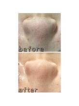 エクスクラメーションマーク(!!!)/ハイドラフェイシャル★