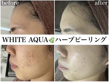 ホワイトアクア 錦糸町店(WHITE AQUA)/ハーブピーリング/東京/錦糸町
