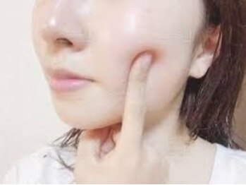 エステティック ベルミランダの写真/【No.1肌管理革命!艶肌美人】水光美グルタチオン+幹細胞導入+美肌毛穴洗浄!透き通るような透明感で艶肌に！