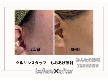 ツルリン 船橋店(TSURURIN)/もみあげ脱毛も効果抜群！