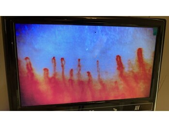 リプレサ バイ エステマニア(Ripresa)/毛細血管