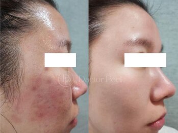 スピカ(SPICA)/ダクトピール