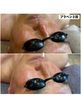 アンリミット(Unlimit)/お鼻のシミが2回で綺麗に！
