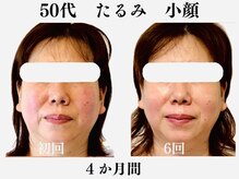 ランティル(l’until)の雰囲気(年齢を重ねたお顔の脂肪・二重あごに!老け顔→ハリのある小顔へ)