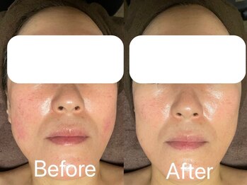 アフター(AFTER)/赤みを落ち着かせたい方