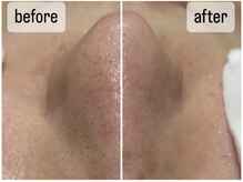 バブル(BUBRU)/ウルトラ毛穴洗浄1回