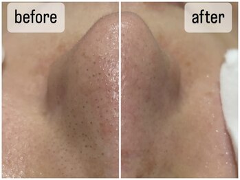 バブル(BUBRU)/ウルトラ毛穴洗浄1回