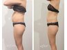 【お腹集中攻め】本格痩身☆最新キャビ×EMSでお腹360度脂肪撃退70分13,000→