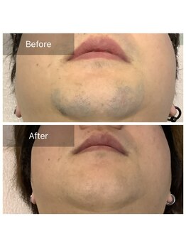 ルシア(Lucia)/ヒゲ脱毛