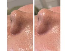 リムビューティー 自由が丘(RymBeauty)/毛穴ケアや毛穴引き締めにも