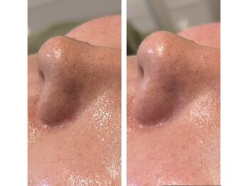 リムビューティー 自由が丘(RymBeauty)/毛穴ケアや毛穴引き締めにも