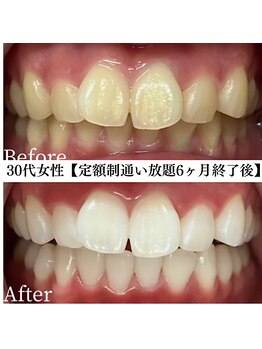 ホワイト 福岡天神店(WHITE)/ホワイトニングビフォーアフター