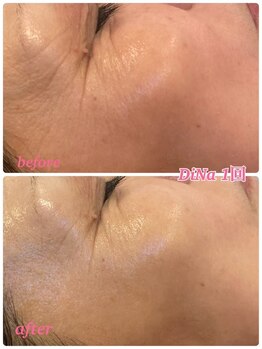 ミレボ(Me.rebo)/水光ケアのB→A