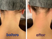 ワクシングサロン ツィター(Waxing salon zither)/【新大阪/西中島】うなじ