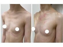 ワイサロン(Y salon)/20代/バストアップ/7ヶ月