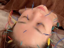 オン 蕨駅西口(ON)/美容鍼【小顔/ほうれい線】