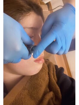 グラン/特許出願中の最先端の美容鍼