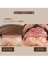 エミニナル(EMININAL)/【バストケア】ビフォーアフター