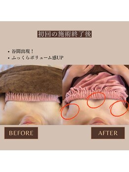 エミニナル(EMININAL)/【バストケア】ビフォーアフター