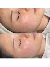 ジョンミー(JONMEE)/ニキビケア・肌質改善に毛穴洗浄