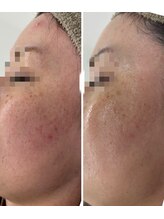 プログレス(PROGRESS)/敏感・乾燥肌エイジング