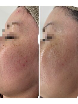 プログレス(PROGRESS)/敏感・乾燥肌エイジング