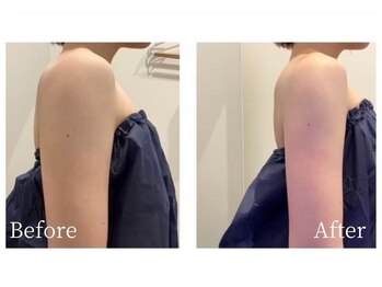 ミスティア(mistia)/エステ【二の腕】1回/After