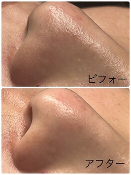 ポマイカイ 名古屋丸の内店(pomaikai)の写真/毛穴洗浄で汚れた角質を除去！名古屋のエステで感動の毛穴ケアを体験♪