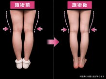 ヨサパーク アカーシャ(YOSA PARK AKASHA)/５回目での変化。