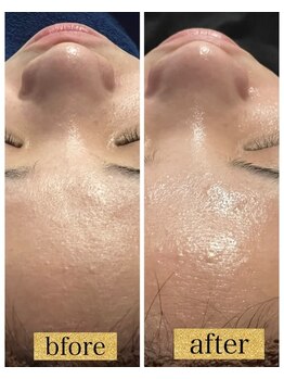 リラクゼーションサロンブラン(Bulan)/毛穴洗浄+高濃度美容液