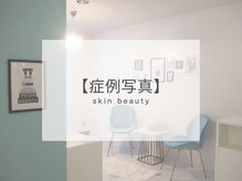 【毛穴｜ハーブピーリング】韓国肌管理Belle 姫路/ハーブピーリング｜写真