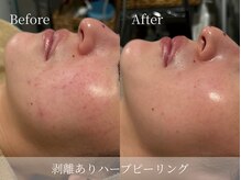 ルミセル(LUMICEL)/赤み/繰り返す肌荒れ