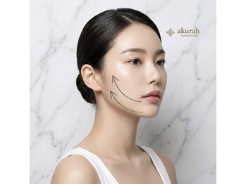 アクラフ 北千住(akurah)の写真/北千住で韓国小顔へ！マイクロウェーブリフトで理想のフェイスラインを叶えよう♪